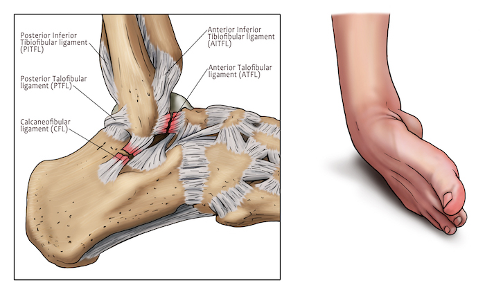 ankle-sprain