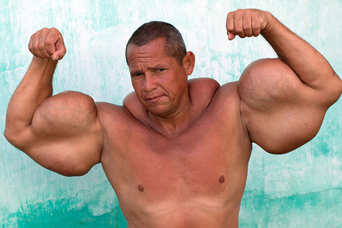 What Is Synthol And Why Are Guys Using It?